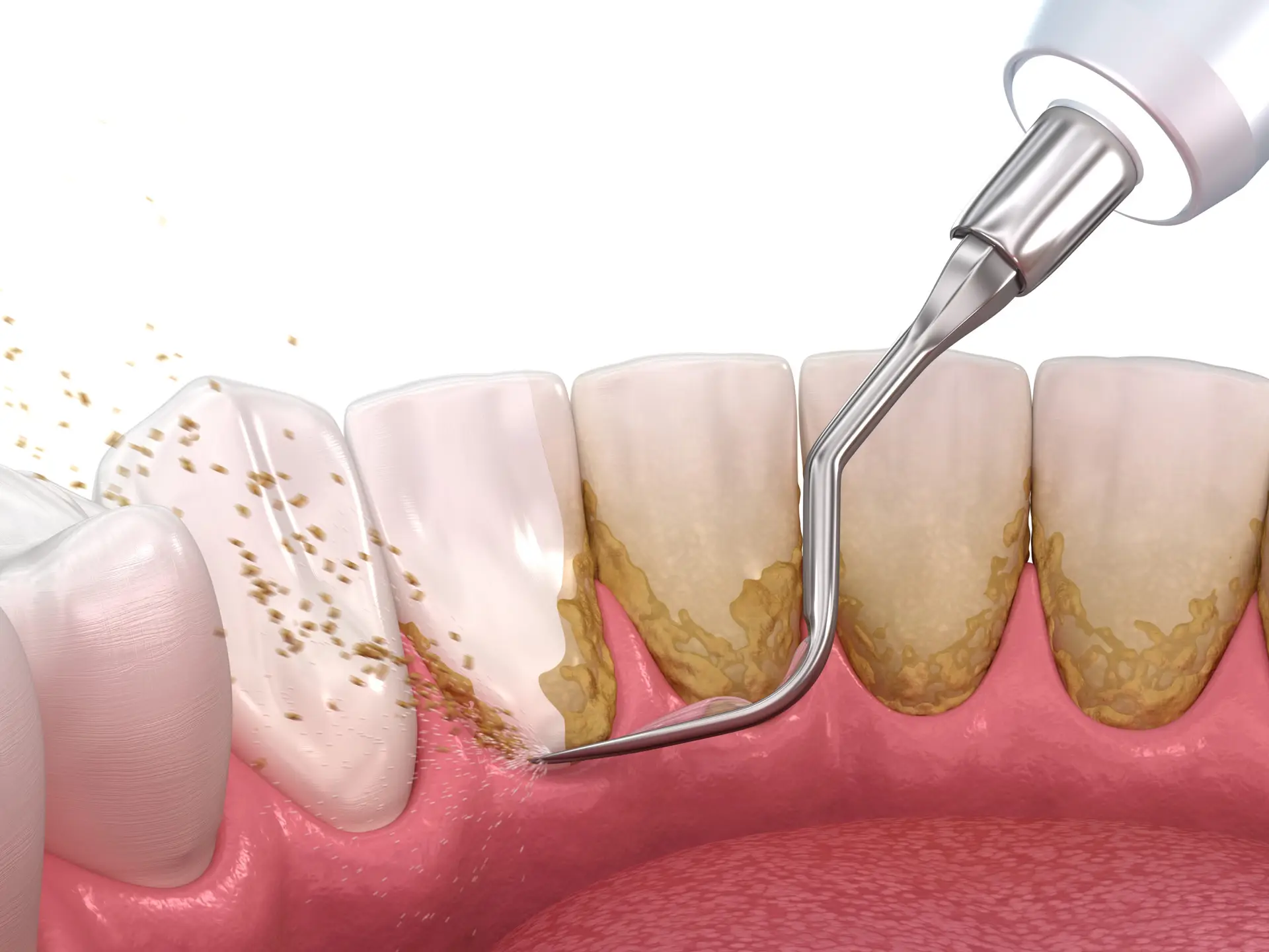 Oral,Hygiene:,Scaling,And,Root,Planing,(conventional,Periodontal,Therapy).,Medically